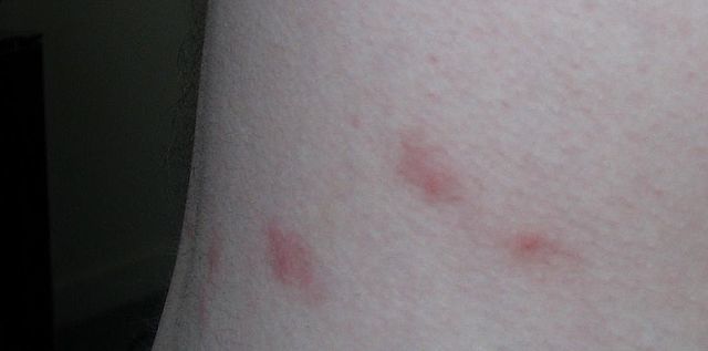 What do flea bites look like on dog human reddish itchy lumps